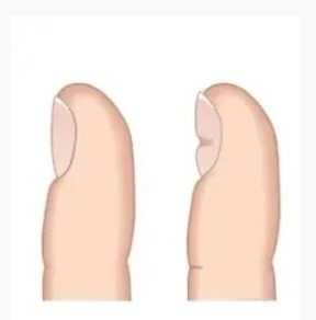 Do your nails have "beauty" lines? 