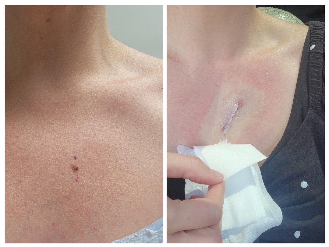 PSA: Go. To. The. Dermatologist. 