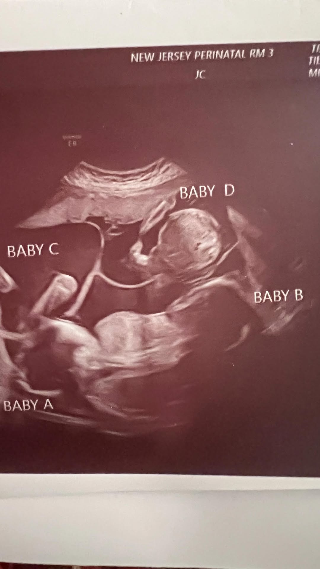 Quadruplets in New Jersey: A rare family story