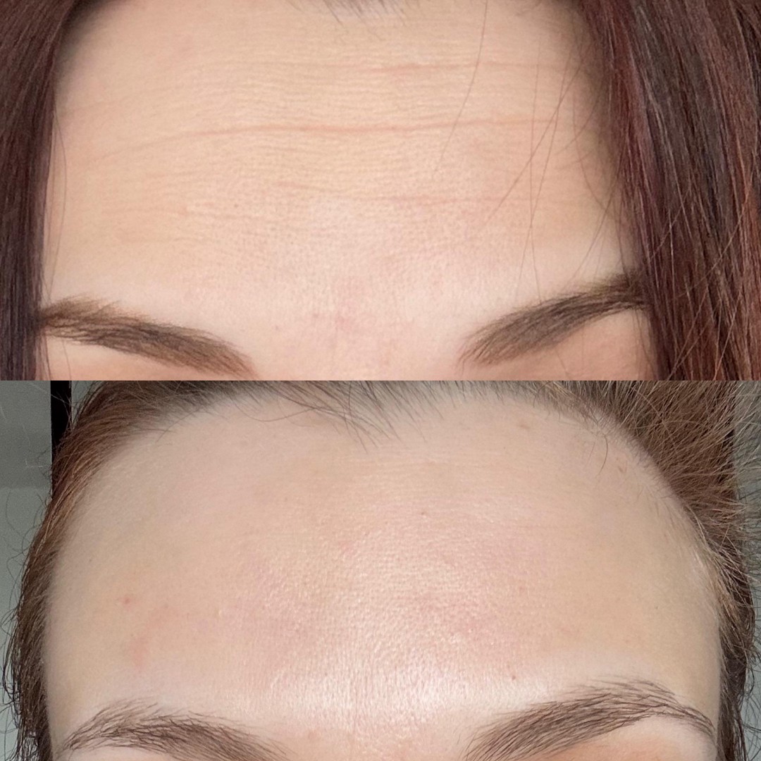 9 Months of Skincare Progress 