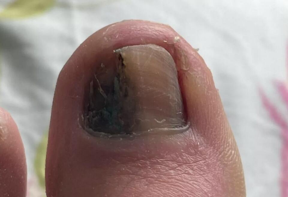 That “Bruise” on Your Toe? Read This!