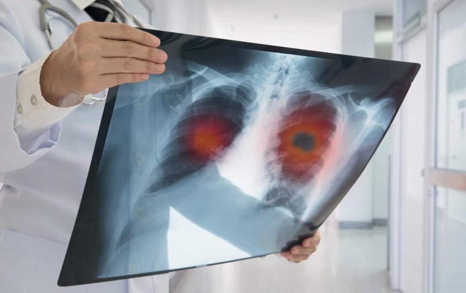 Covid & Flu: Hidden Cancer Risk?