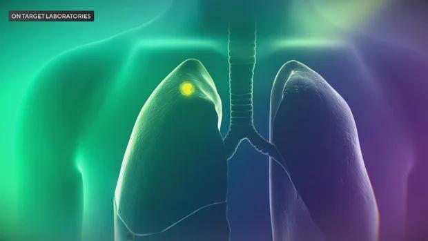 This green light tech is changing lung cancer surgery