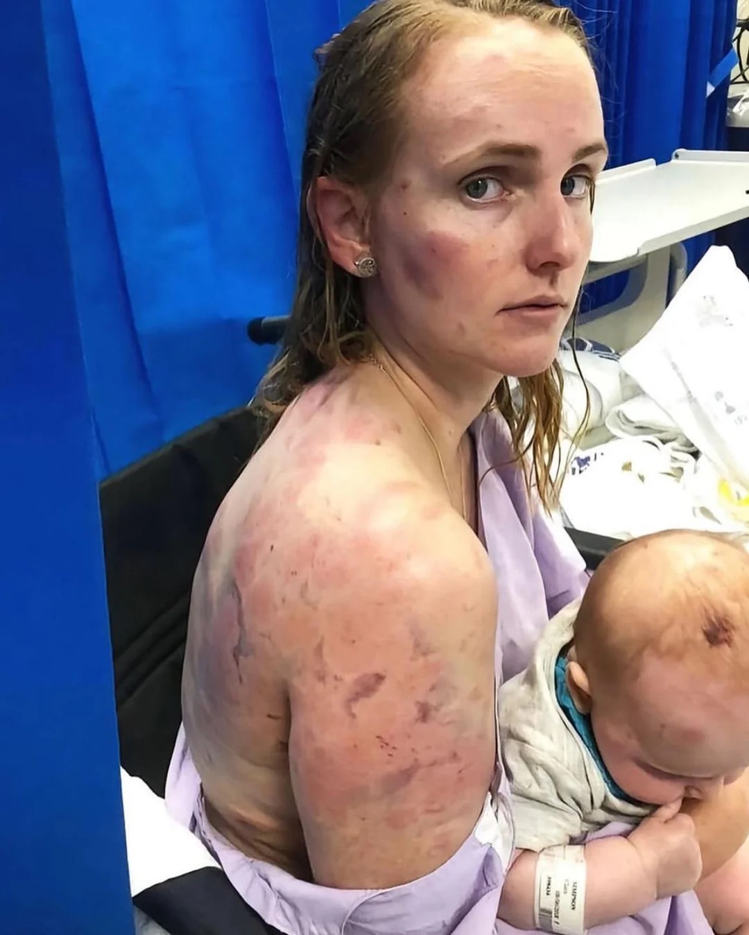 Australian mom uses her body as a shield to protect her baby during a hail storm😭😭😭