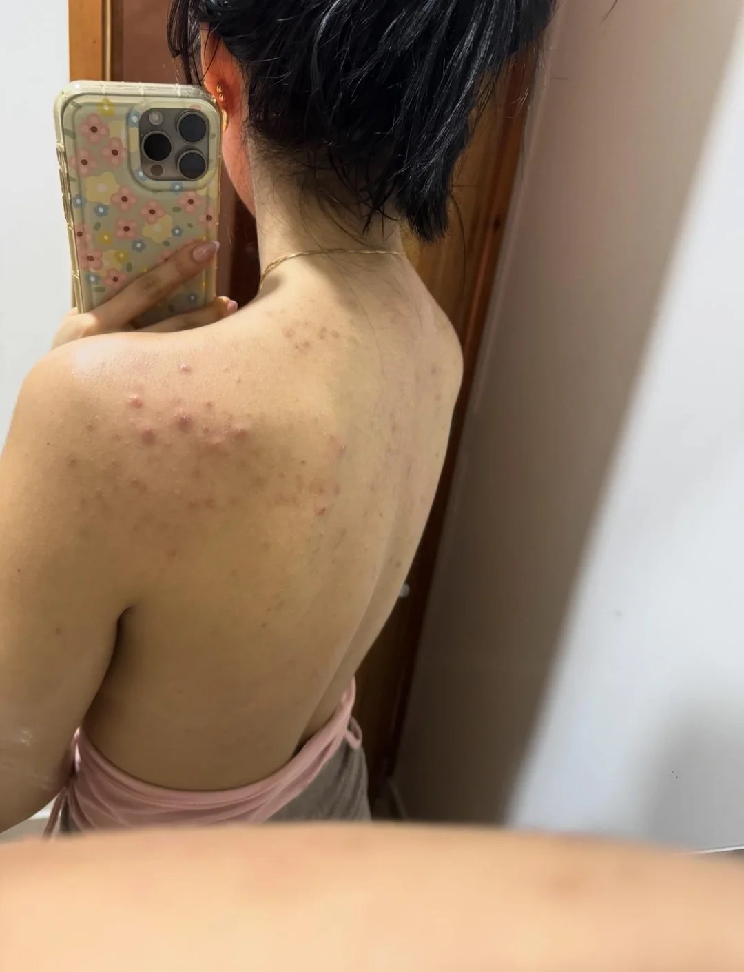 The Skin Got Clear After a Week of Sun Exposure?! (B&A)🤯
