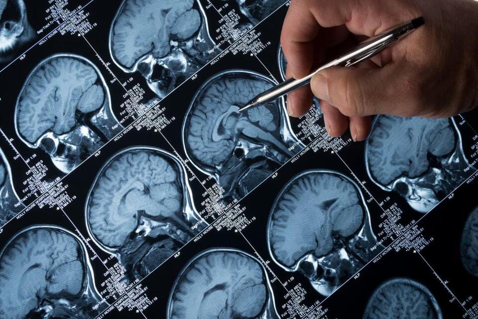 Alzheimer’s Drug Could Change Everything