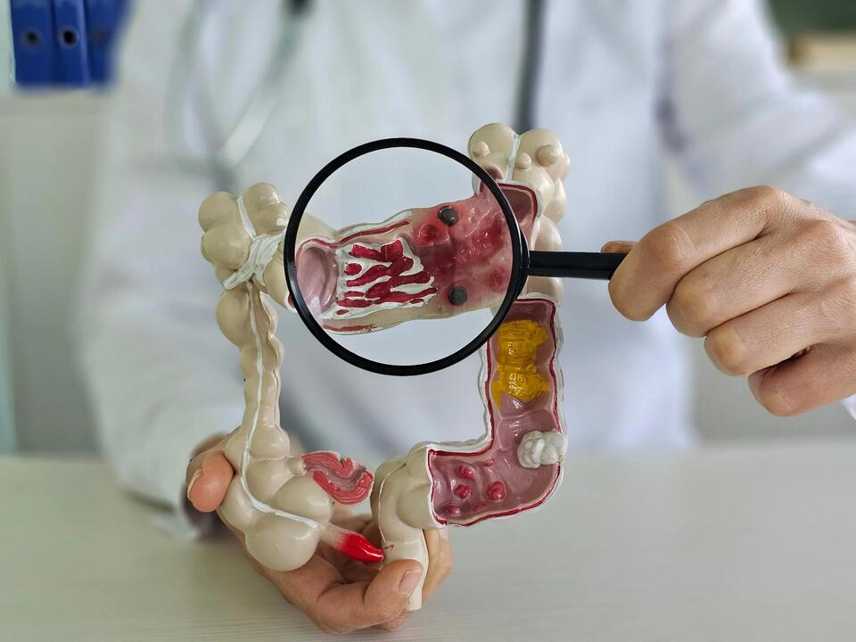 Colorectal Cancer Rates Rising in Young Adults
