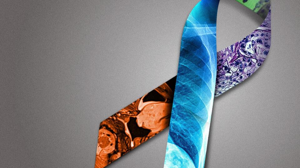 Colorectal Cancer Screenings Catching More Cases