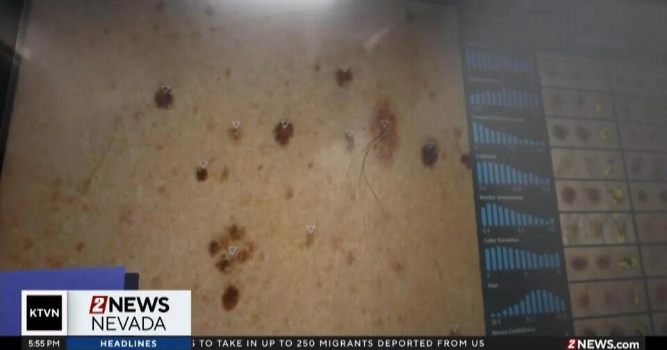 Melanoma Cases Up, But Deaths Down!