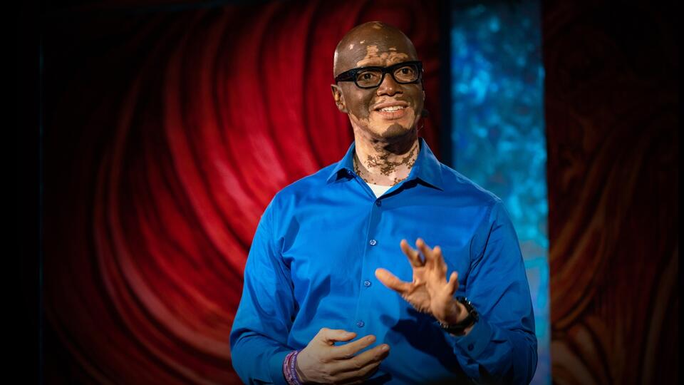 Lee Thomas Gets Real About Vitiligo