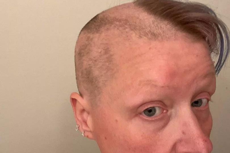 Finding freedom in baldness: Amanda’s journey