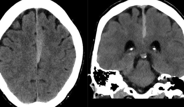 UC’s Big Bet on Brain Bleeds & Blood Thinners