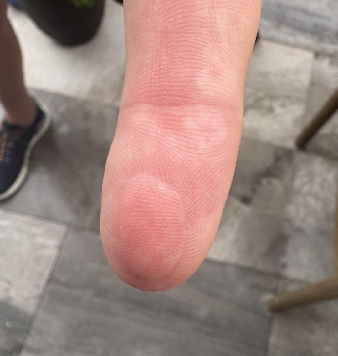 *Man accidentally severs finger pad and doctor accidentally sews it on upside down 😂😂