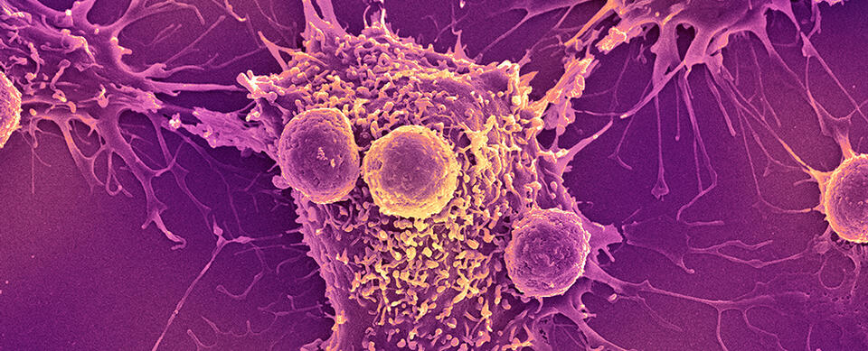 Game-Changer: New Cancer Vaccine Shows Real Results