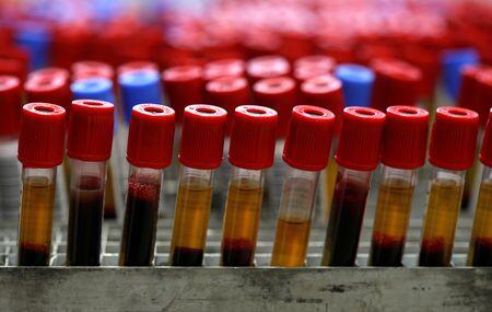 Game-Changer: Early Ovarian Cancer Blood Test
