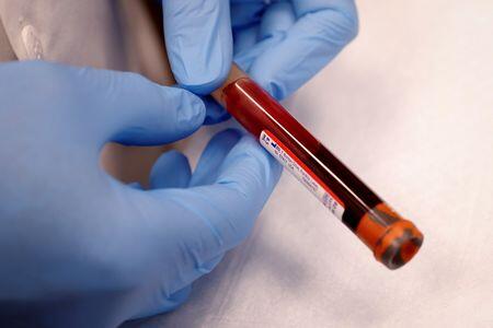 Game-Changer: Early Ovarian Cancer Blood Test