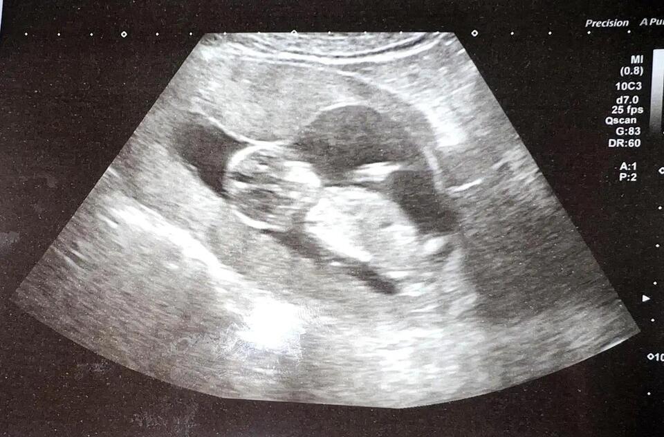 When Morning Sickness Isn’t Just Morning Sickness