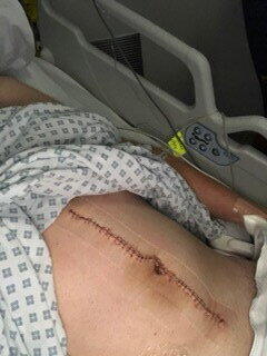 Stomach pain turned out to be stage 4 cancer