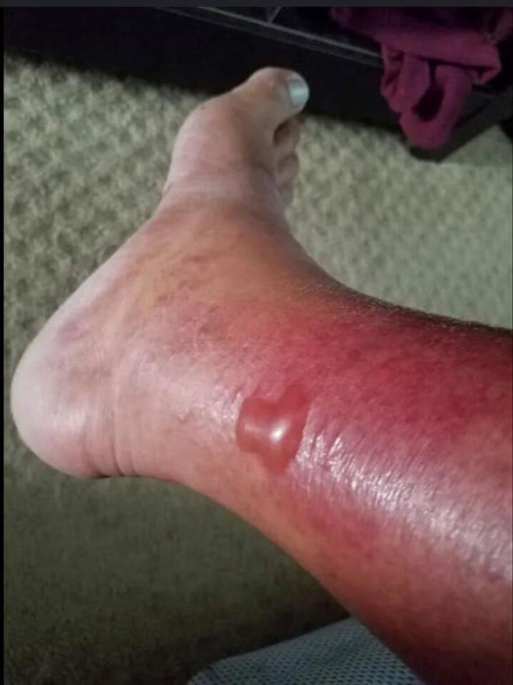 Flesh-Eating Bacteria at the Beach?!