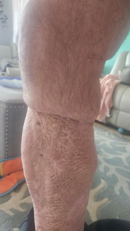 Flesh-Eating Bacteria at the Beach?!