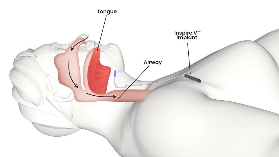 West Michigan’s new hope for sleep apnea
