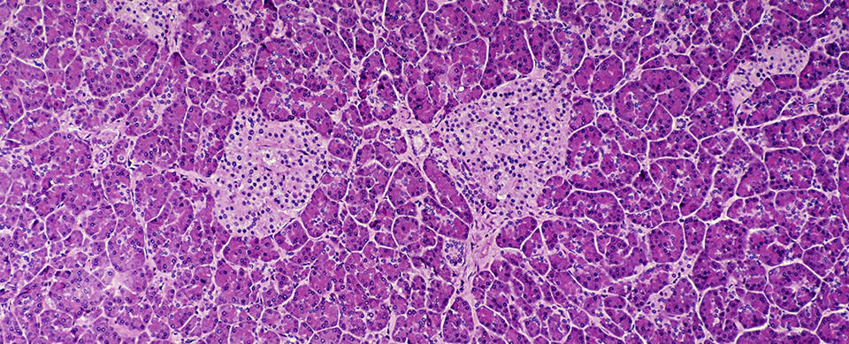 Sugar Cloak Trick Could Stop Type 1 Diabetes