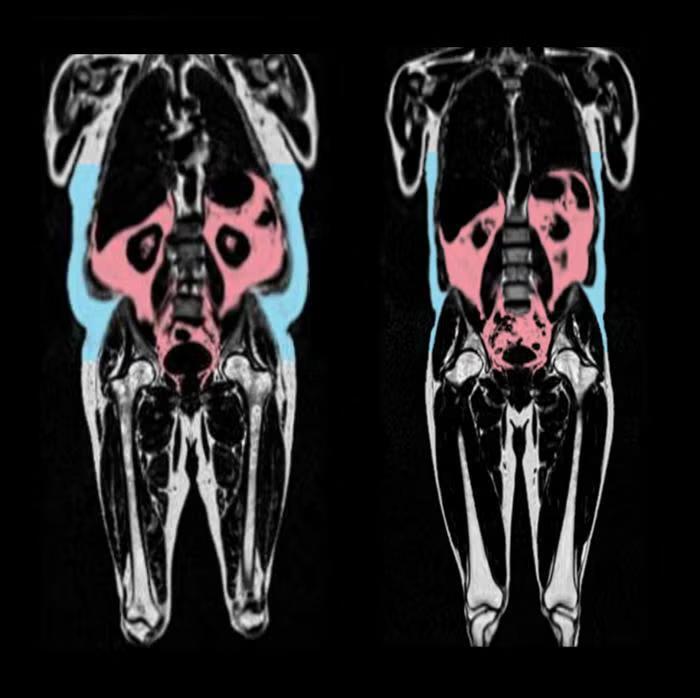 That Sneaky Fat Could Be Aging Your Heart