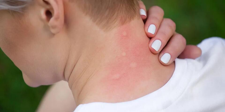 I Study Mosquitoes. Still Get Bitten