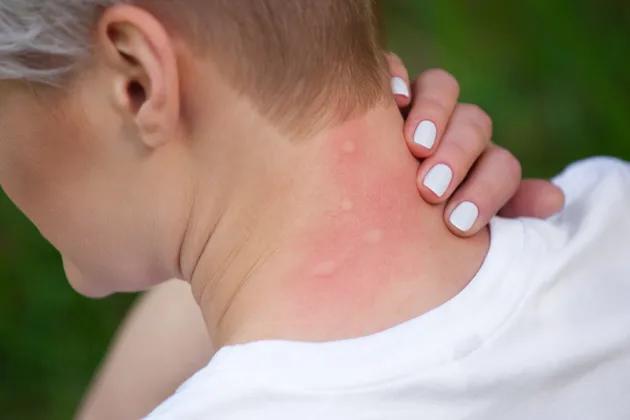 Why Mosquitoes Love Some of Us More