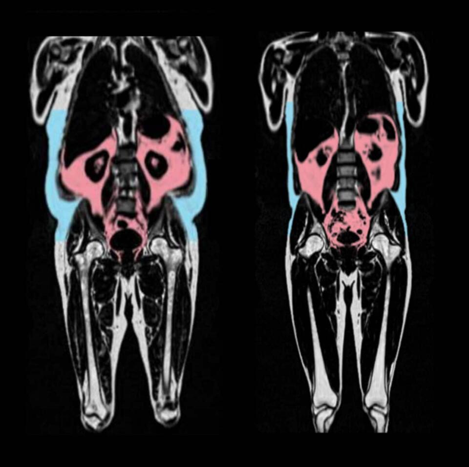 Where Your Fat Hides = How Old Your Heart Feels
