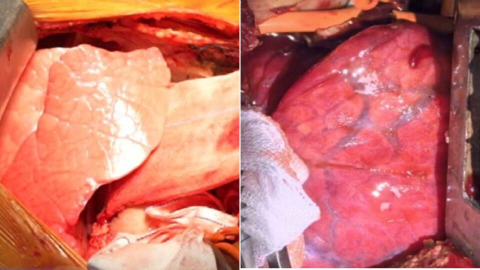 Pig Lung Transplant: Wild Science or Future Fix?