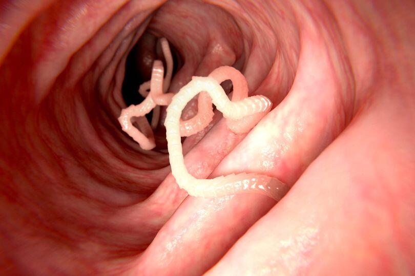 Undercooked Bacon Nightmare: Pork Worms in Brain?!