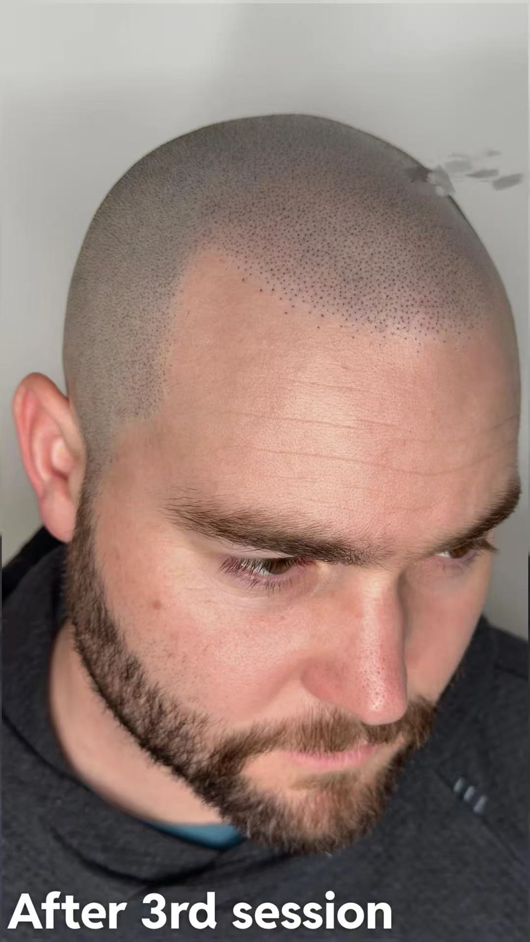 It's Not a Hair Transplant, It's a Hair Tattoo for a Natural Look (but if you're already bald??