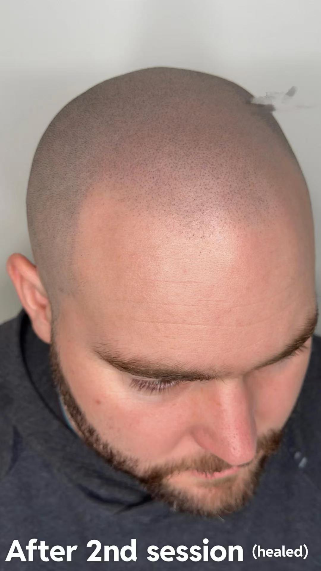 It's Not a Hair Transplant, It's a Hair Tattoo for a Natural Look (but if you're already bald??