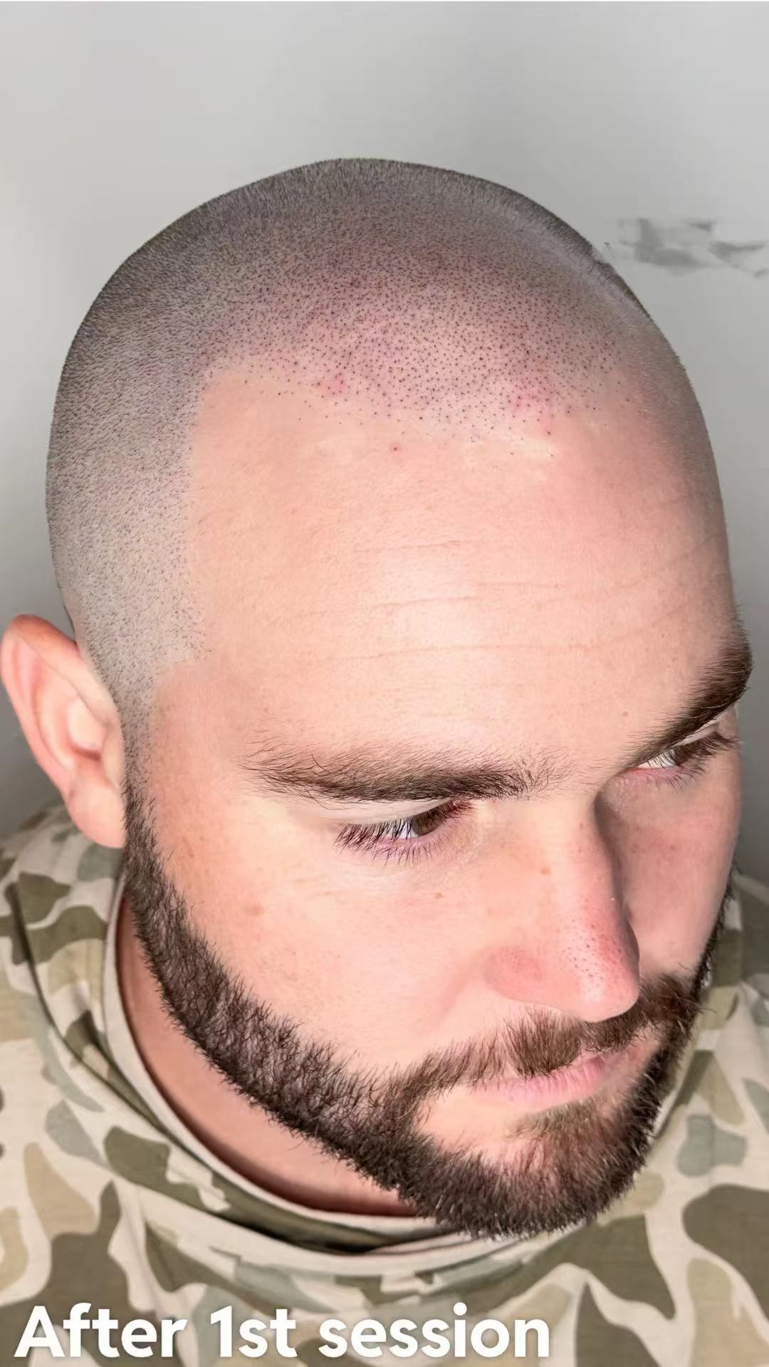It's Not a Hair Transplant, It's a Hair Tattoo for a Natural Look (but if you're already bald??