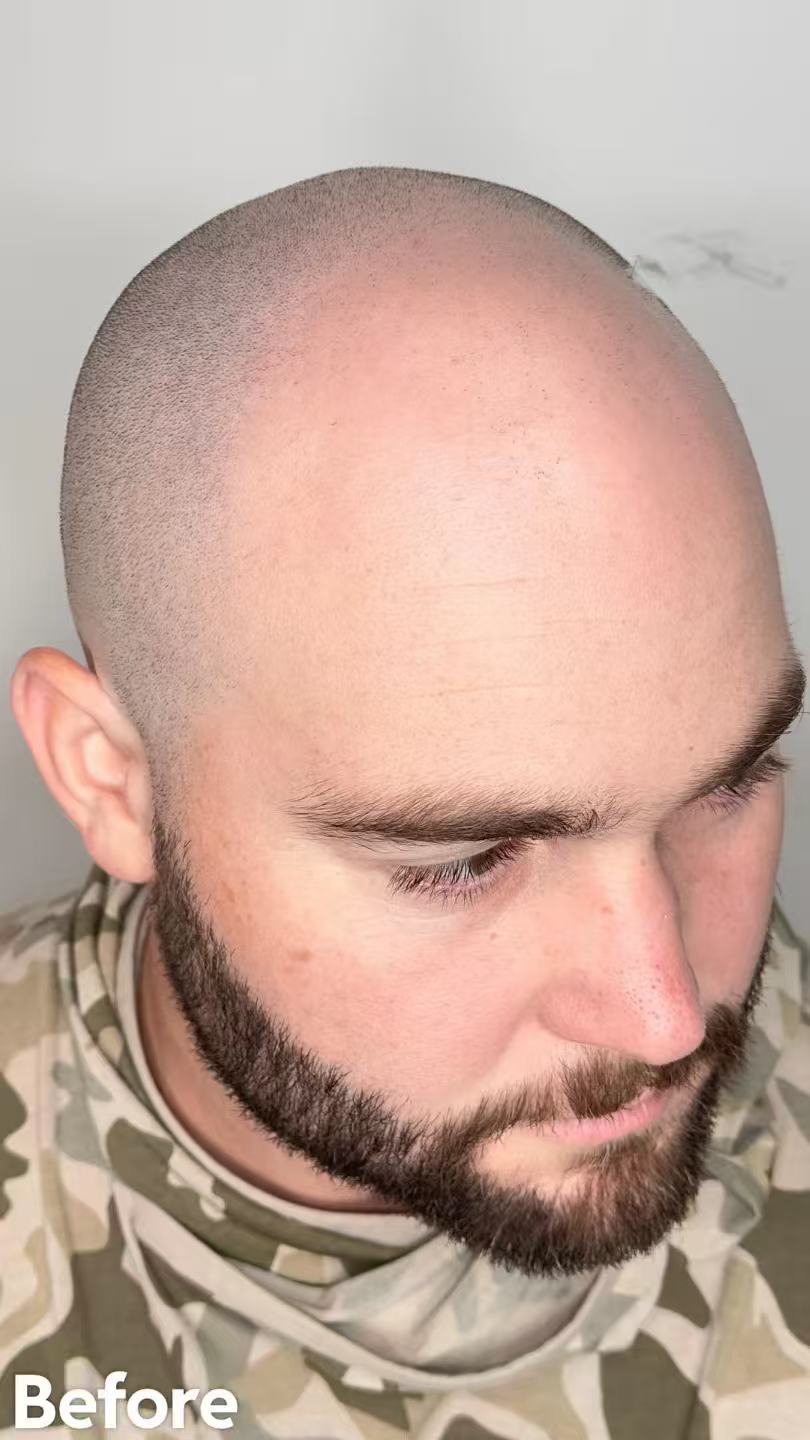It's Not a Hair Transplant, It's a Hair Tattoo for a Natural Look (but if you're already bald??