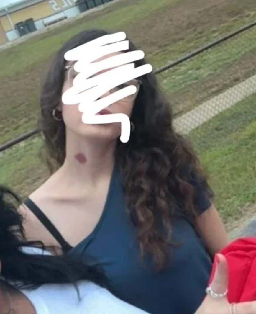With this birthmark, you'd always get asked the most awkward questions