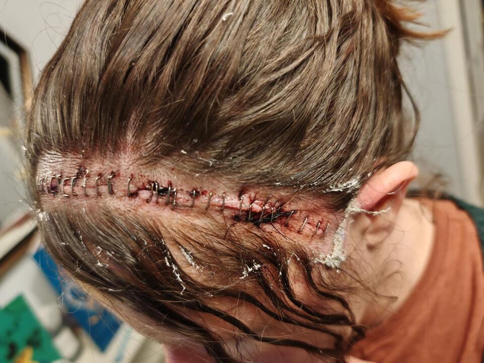 Kent mum’s 20-year migraine mystery solved