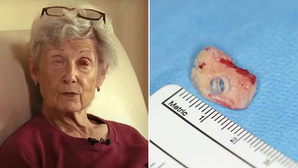 She Can See Again—Thanks to a Tooth in Her Eye!