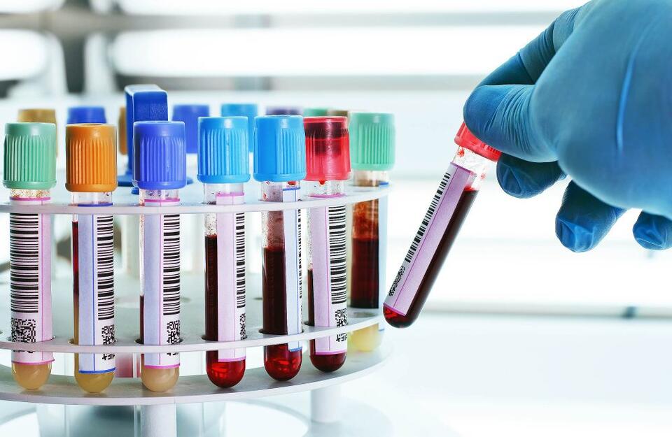 Alzheimer’s blood test changes everything