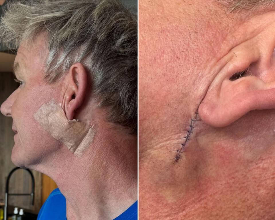 Gordon Ramsay’s Skin Cancer Wake-Up Call