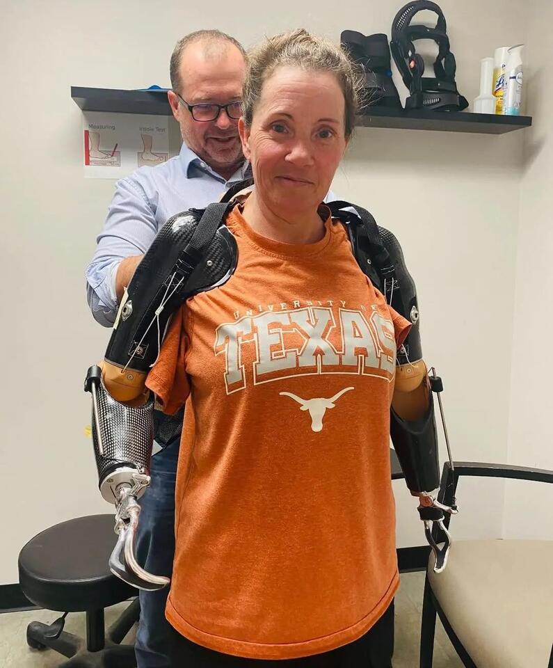 Texas mom’s fight for prosthetics after dog attack