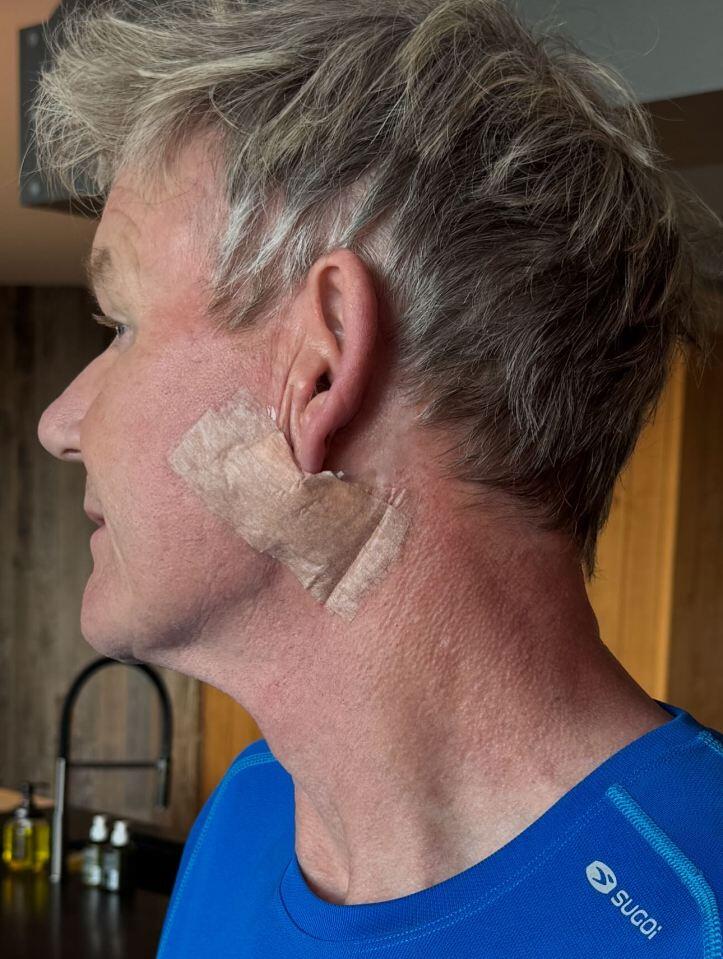 Gordon Ramsay’s Skin Cancer Scare & Big Comeback