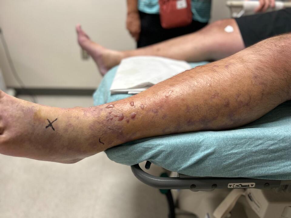 Florida dad battles rare flesh-eating infection
