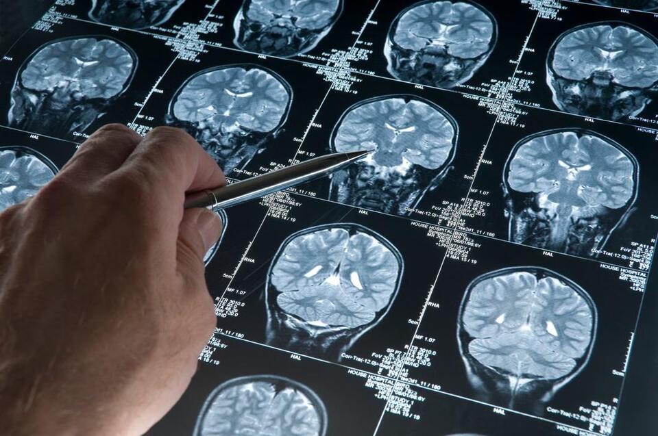 AI’s Fast Lane: Stroke Recovery Reimagined