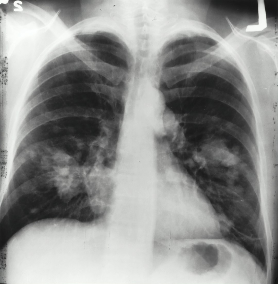 More women are getting lung cancer without ever smoking. This is so crazy.