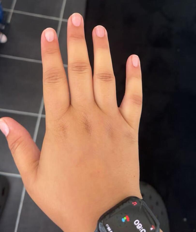 Living with a rare autoimmune disorder at 23