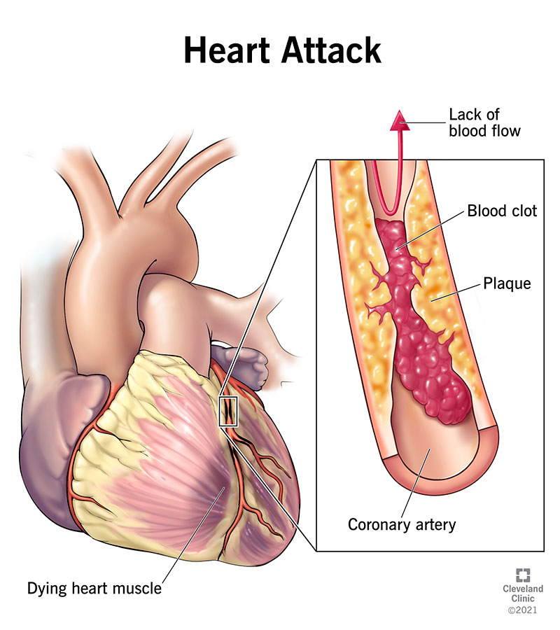💔 The heart attack signs women are taught to ignore