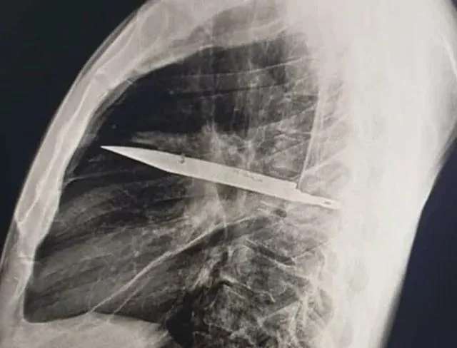 Man Discovers Knife Stuck in Chest for 8 Years—After Pus Starts Oozing😨