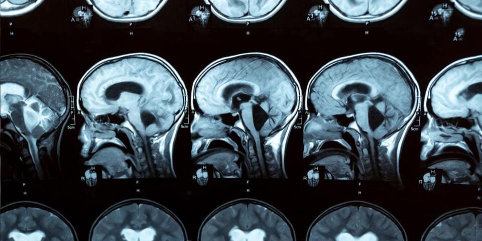 Your Brain’s Secret Alzheimer’s Clue?